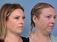 Upper-jaw before and after the therapy