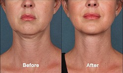 Before bed, and after double chin, lifting